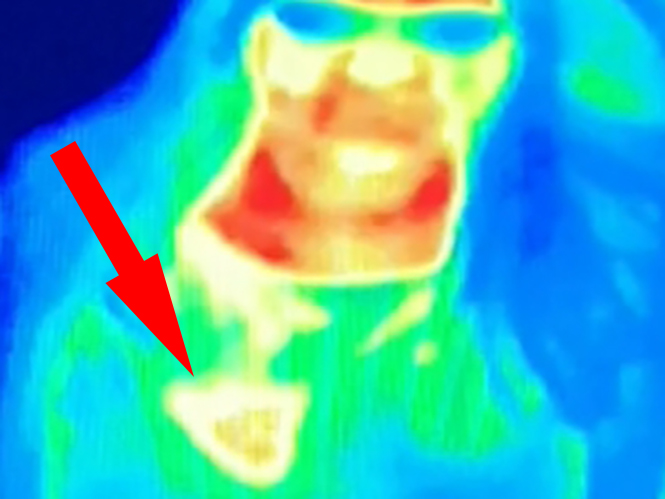Θερμική κάμερα σε μουσείο αποκάλυψε σε μία γυναίκα ότι έχει καρκίνο του μαστού